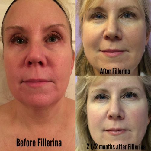 pictures using fillerina