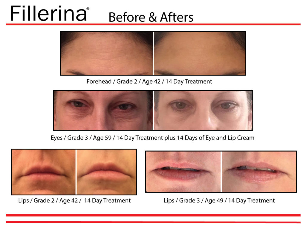 Fillerina® USA