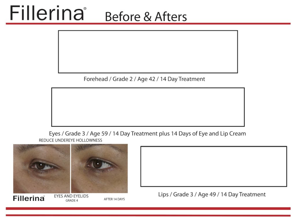 Fillerina® USA
